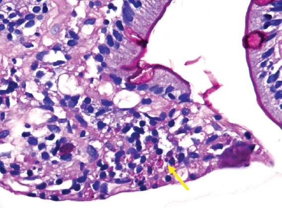 Biopsy of duodenal ulcer (PAS, ×40) showing histiocytic infiltration of the lamina propria with PAS positive intracytoplasmic yeast forms.